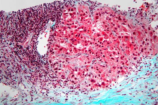 Un fármaco usa la glucosa para frenar la expansión del cáncer en ratones